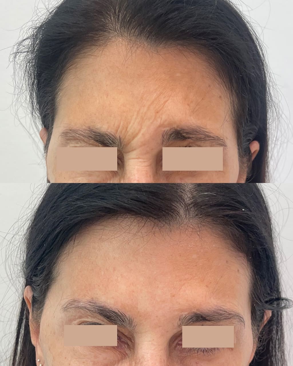 Resultado toxina botulínica - DC Clinic