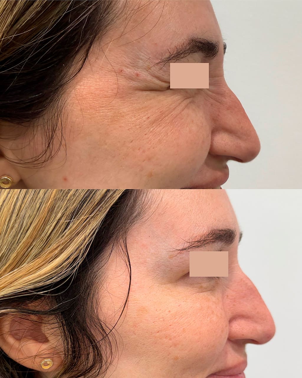 Resultado toxina botulínica - DC Clinic